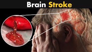 What Happens In Brain Stroke? | Ischemic And Hemorrhagic Stroke