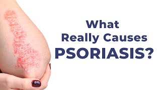 What Really Causes Psoriasis? | August Psoriasis Awareness Month