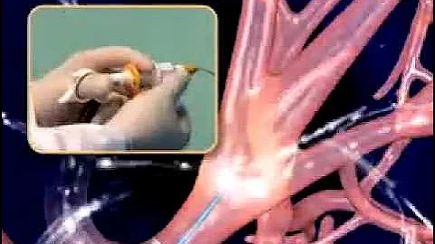 Electromagnetic Navigation Bronchoscopy - Cabell Huntington Hospital