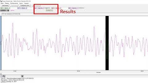 Electroencephalography