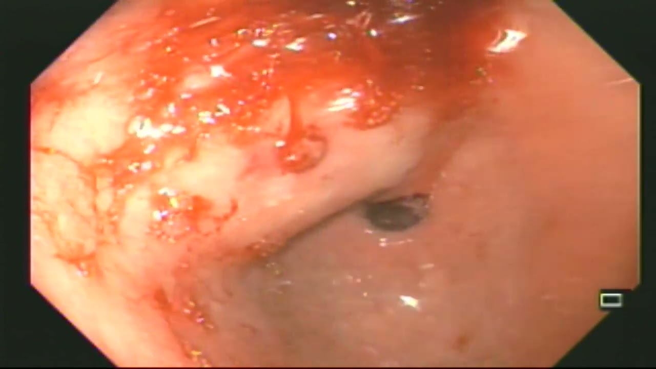 Upper Gastrointestinal Bleed