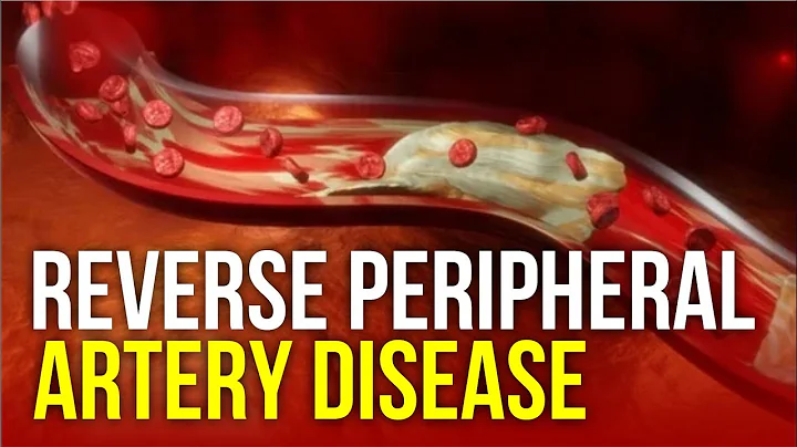 How Can You Reverse Peripheral Artery Disease? #legpain