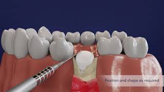 Download Lagu How to Prepare and Place EthOss Instructional Explainer Animated Video MP3