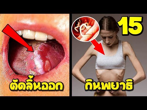 15 วิธีลดน้ำหนักแบบพิสดารของคนทั่วโลก ที่อันตรายมากๆ (บ้าไปแล้ว)