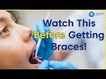 What to know before getting braces  8 tips to prepare you for braces