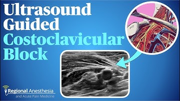 Costoclavicular Brachial Plexus Block