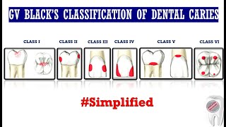 GV Black's Classification of Dental Caries Gv Blacks Classification
