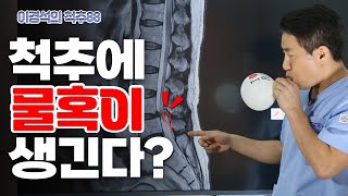 알수 없는 허리 통증, 척추의 ‘물혹’을 확인하라? 후관절 낭종! - 이경석의 척추88 #170 - 협착증, 후관절낭종