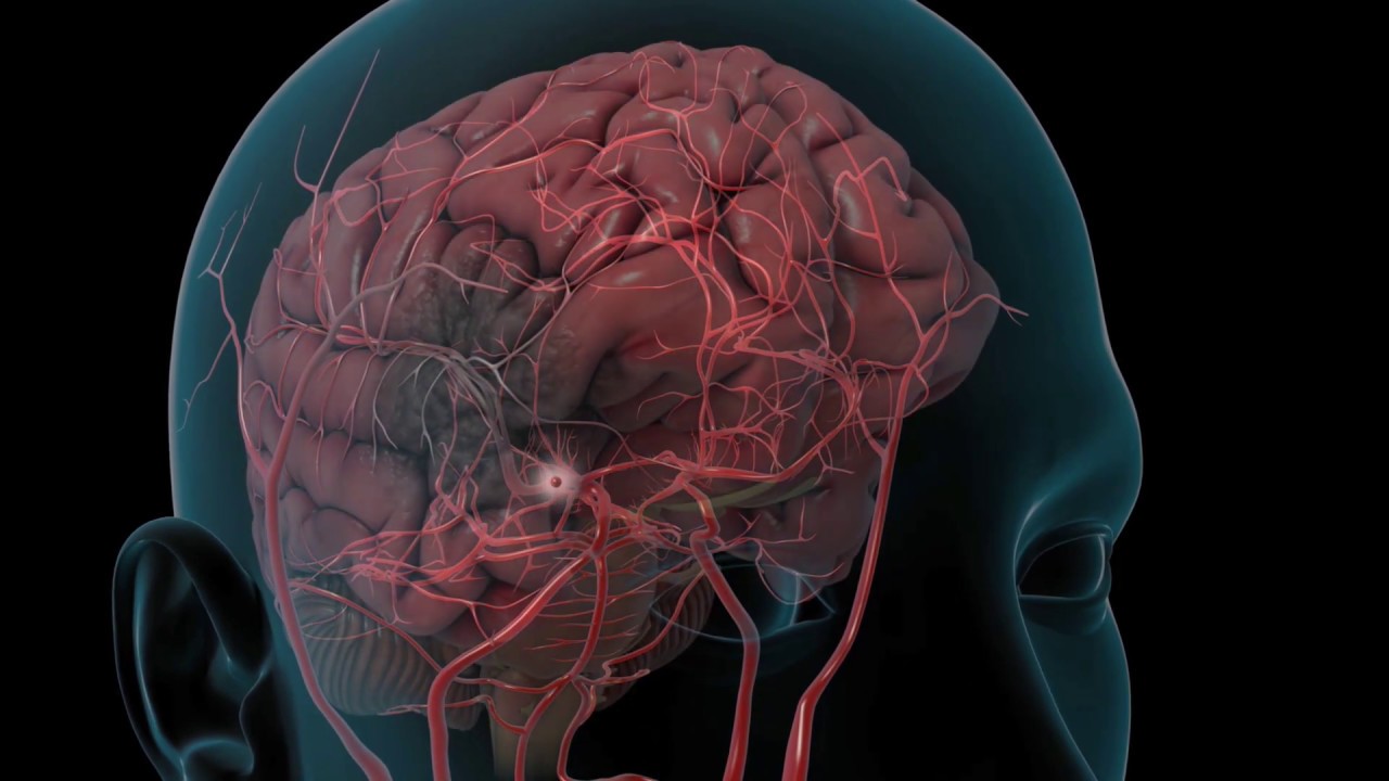 Инсульт фото для презентации