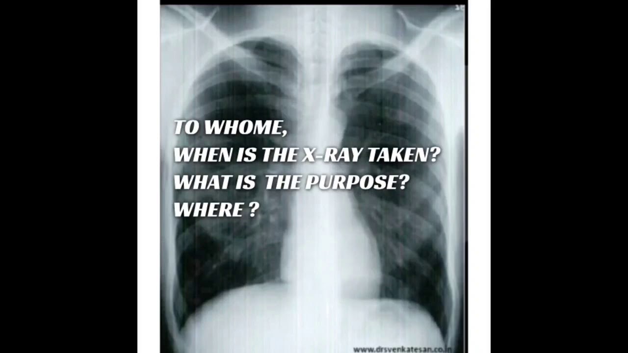 HOW TO READ A CHEST X RAY, AND WHAT TO KNOW FROM IT!! PRECISE AND EASY
