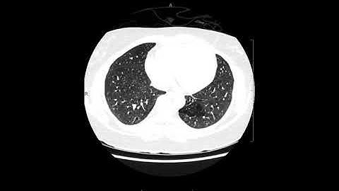 Classic intralobar sequestration on CT.