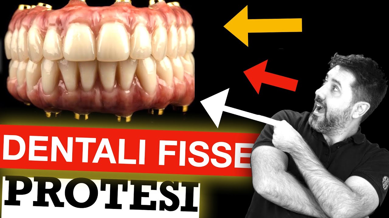 🔥PROTESI DENTALI FISSE 🔥 IMPIANTI DENTALI e Denti Fissi in Moldavia