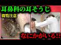 【巨大な耳垢】耳鼻科での耳掃除ってこうなってます!
