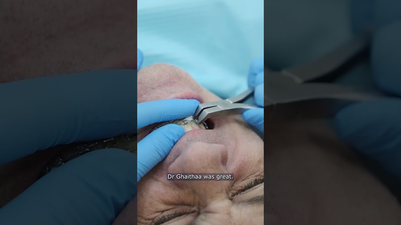 Damon Braces Testimonial  #dentist #dentalexperience #dentaltreatment #dentaltestimonial