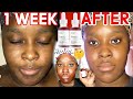 The Ordinary AHA 30% BHA 2% Peeling solution! Before and After (1 week) | How to Use & How to Layer!