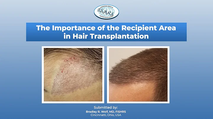 The Importance of the Recipient Area in Hair Trans...
