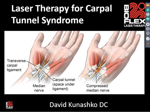 Laser Therapy For Carpal Tunnel Syndrome Webinar Transcription