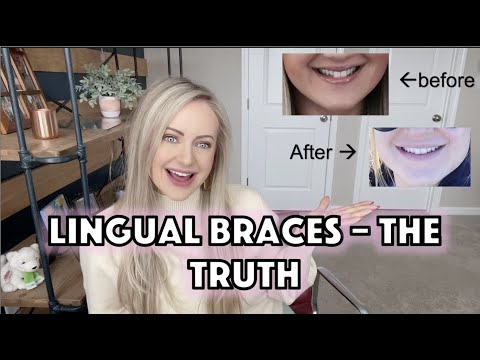 Video: Lingual Braces: Voors En Tegens, Kosten, Comfort, Lisping En Meer
