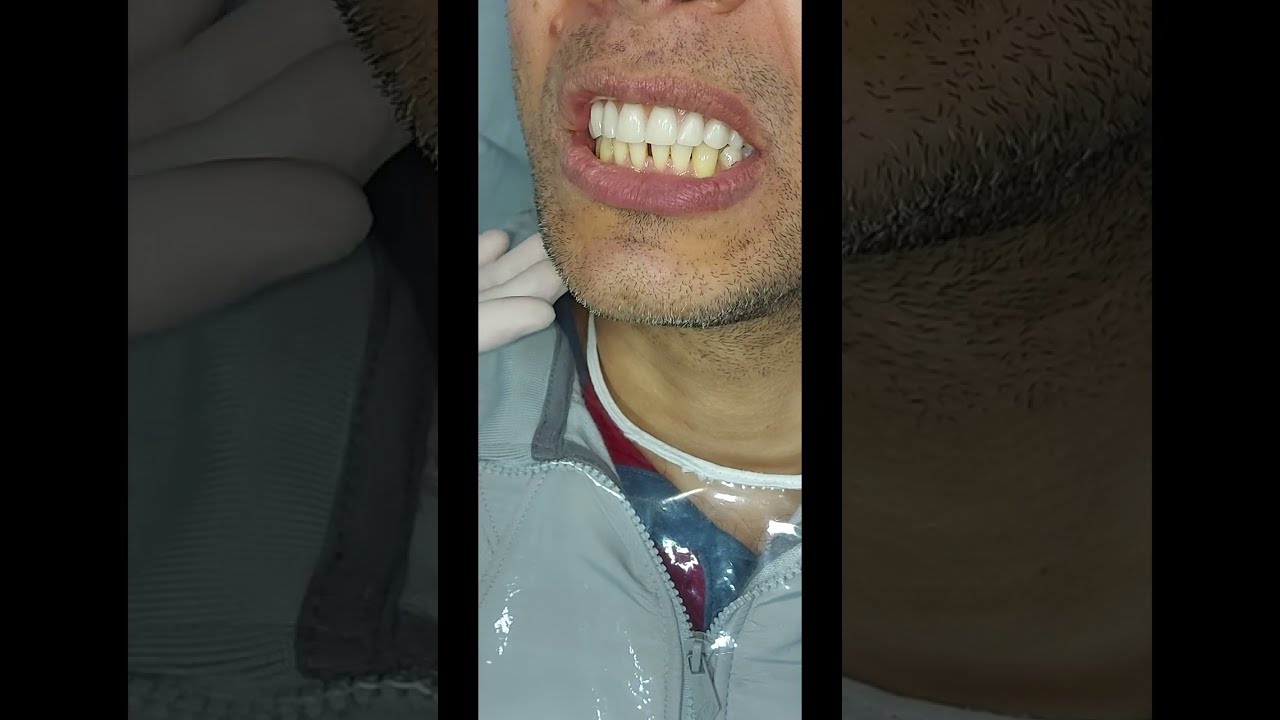 Instala&ccedil;&atilde;o de pr&oacute;tese fixa - protocolo superior - all on four - dentes fixos em Caxias do Sul