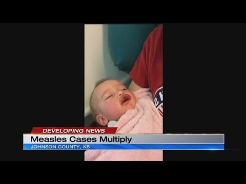 7 people with measles identified in Johnson, Miami counties, Kansas health officials say