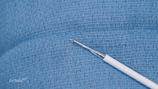 All-Inside Medial Meniscus Repair Using the FiberStitch™ 1.5 Implant