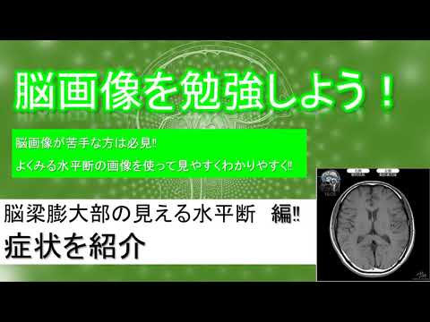 無料で簡単！脳画像の勉強「脳梁膨大部の見える　水平断編　症状紹介」【超簡単解説】