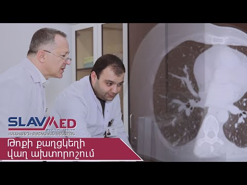 Video: Թոքերի քաղցկեղը կցուցադրվի՞ կրծքավանդակի ռենտգենի վրա: