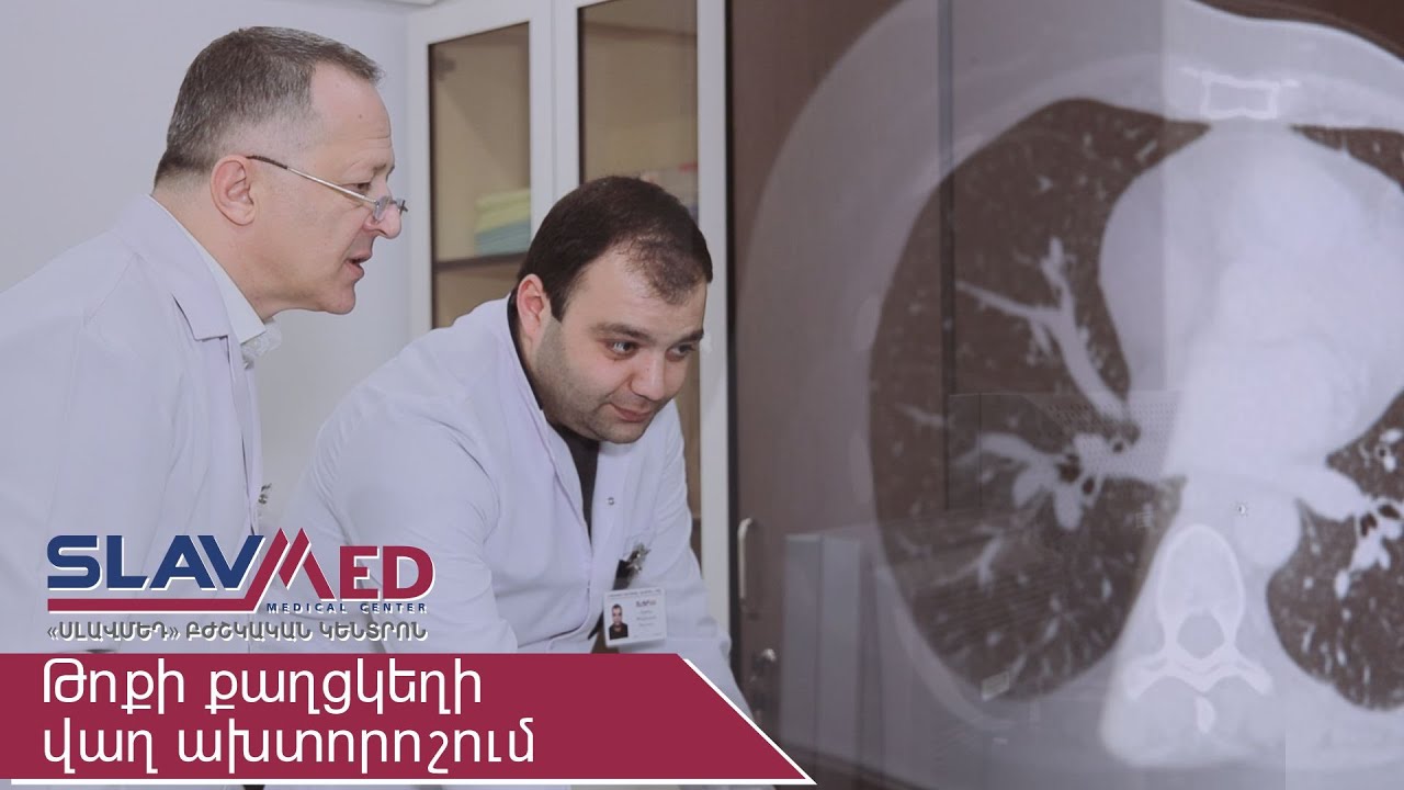 Թոքի քաղցկեղի վաղ ախտորոշում