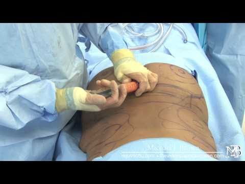 Dr A Trussler Liposuction Surgeon