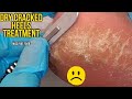 Get Rid of Your Dry Cracked Heels - How to Treat Cracked Heels Full Treatment by miss foot fixer