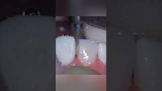 Dental Motivation. Preparation Teeth. Crown Teeth.