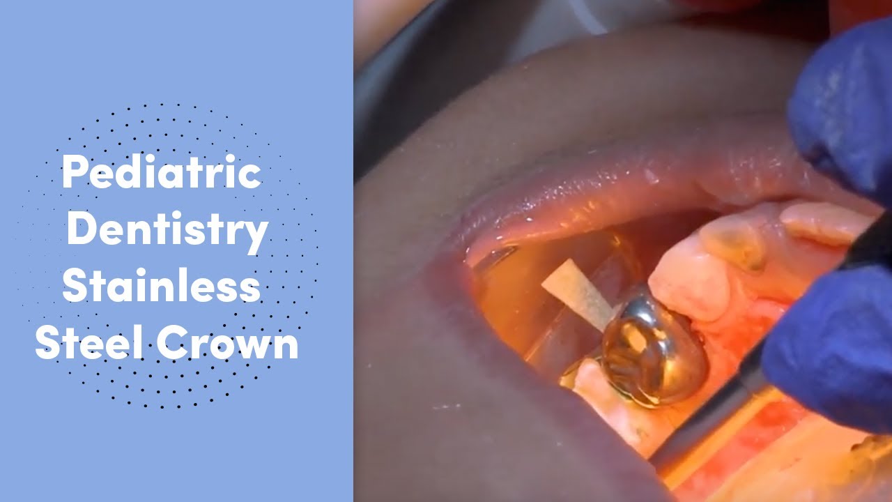 Pediatric Dentistry Procedure Stainless Steel Crown With Dr Ana