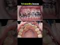 14 months braces. 75% braces journey to complete #braces #orthodontist #dentist #teeth