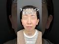 【糸リフト】フェイスライン変えたくて💭#shorts