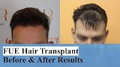 Dr. Bisanga - Hair Transplant Results (3200 FUE 0-12 Months Full-Face +  Testimonials) | BHR Clinic - YouTube