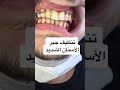 تنظيف جير الأسنان الشديد بالامواج فوق الصوتية Scaling Teeth جهاز الكافيترون 