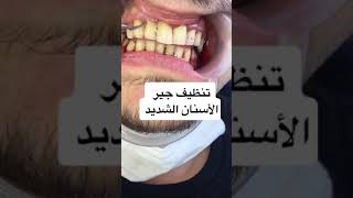 تنظيف جير الأسنان الشديد بالامواج فوق الصوتية scaling teeth ( جهاز الكافيترون)