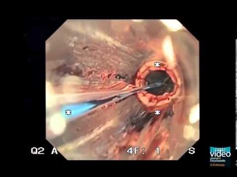 Gastric Cancer and Role of Endoscopic Submucosal Dissection. 