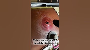 Taking care of your CRT anode cap and potentially solving a ticking issue