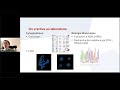 Prise en charge de la leucémie lymphoblastique aiguë | Conférence sur la leucémie
