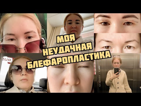 БЛЕФАРОПЛАСТИКА / моя история/ мой опыт/ блефаропластика азиатских век/ ny.zarina