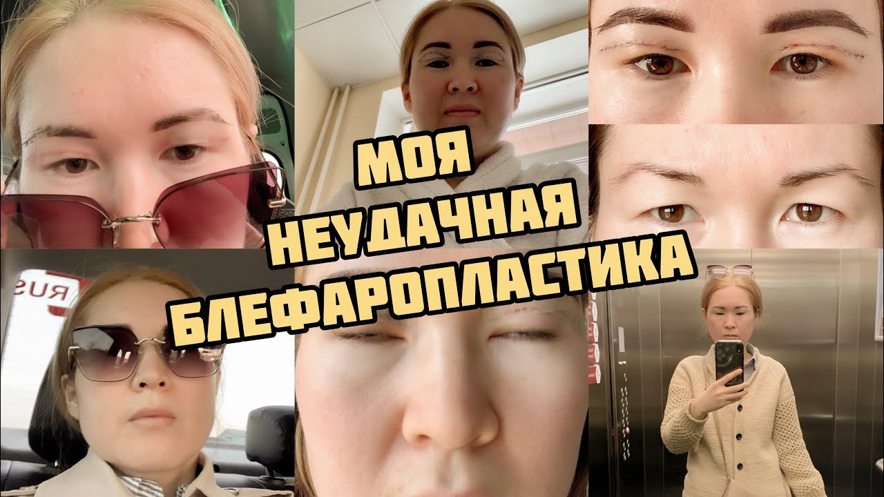 БЛЕФАРОПЛАСТИКА / моя история/ мой опыт/ блефаропластика азиатских век/ ny.zarina