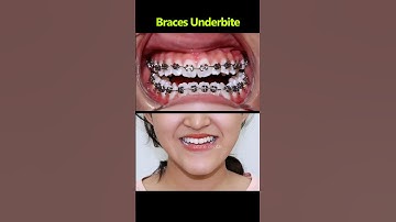 underbite teerh and braces. Ocare can change your smile #braces #dentist