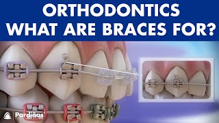 How Braces Work Elements of the orthodontic treatment and its role ©