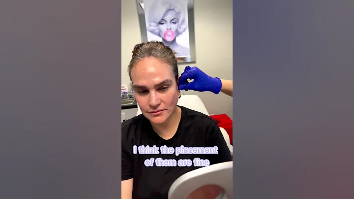 MINT PDO Threads - Before and After | FaceBeauty Med Spa in Doral, FL