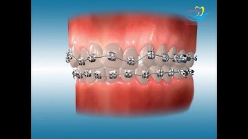 NIỀNG RĂNG KHẤP KHỂNH