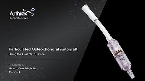 Particulated Osteochondral Allograft Using the GraftNet Device™