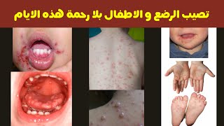 فيروس الهربس و الجديري المائي و مرض اليد و القدم و الفم عند الاطفال اعراضهم و طرق الوقاية و العلاج