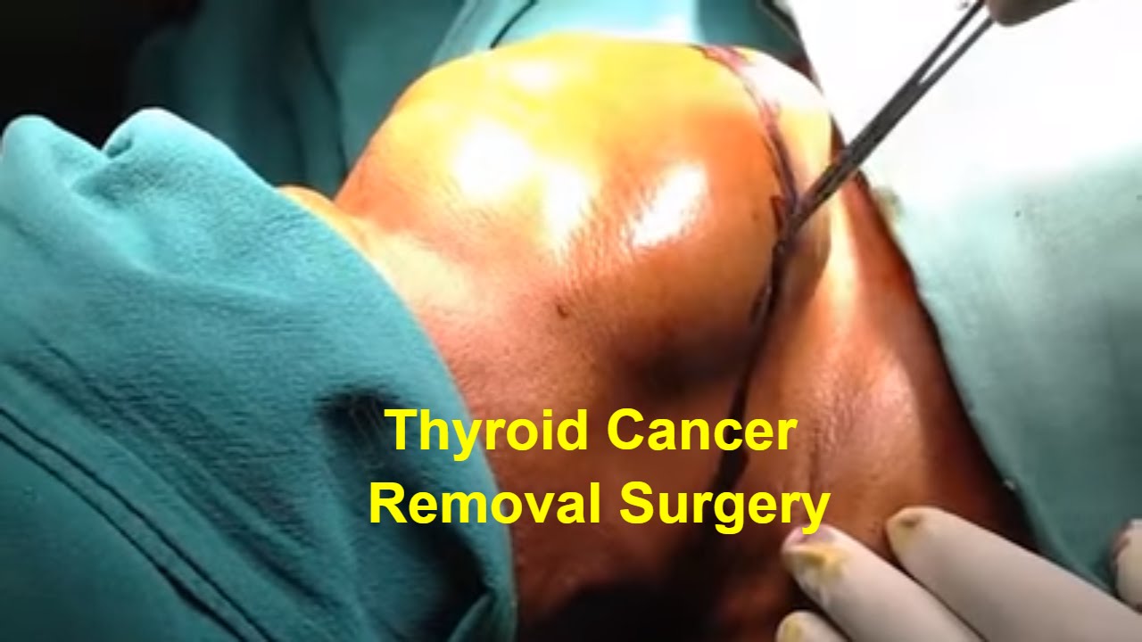 Total Thyroidectomy Removal Surgery by Dr Majid Ahmed
