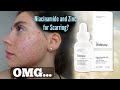 I TESTED THE ORDINARY NIACINAMIDE AND ZINC SERUM FOR MY ACNE SCARS ONE MONTH|| Shocked by this..